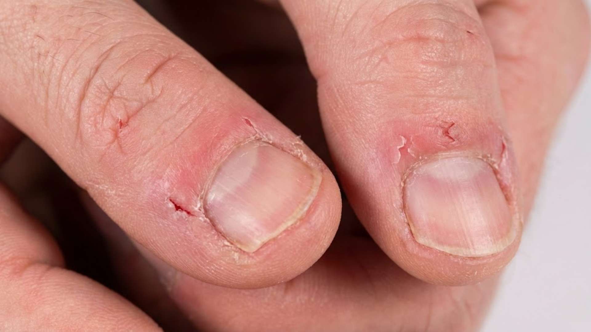 Painful Hangnails That Keep Tearing Stop the Cycle