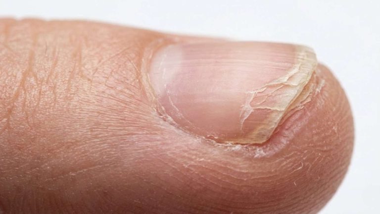 Nails Peeling in Layers at the Tips Causes and Care Tips