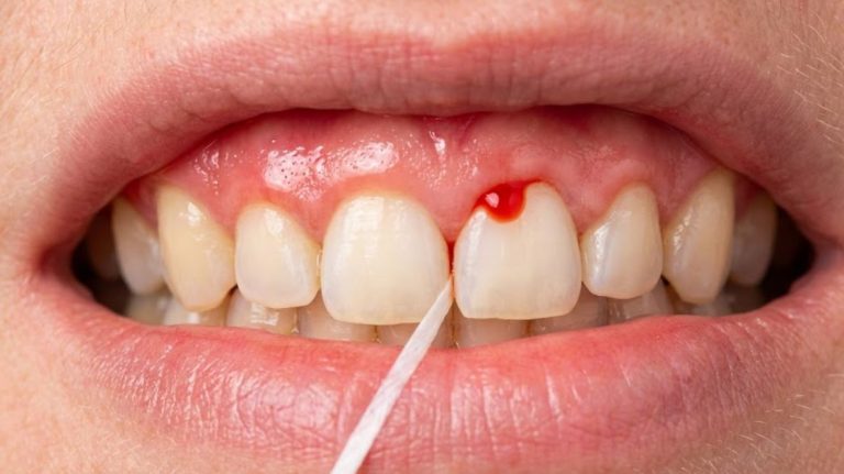 Bleeding Gums When Flossing