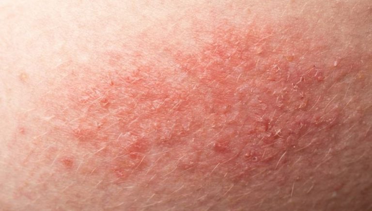 Chafing Between Thighs in Summer