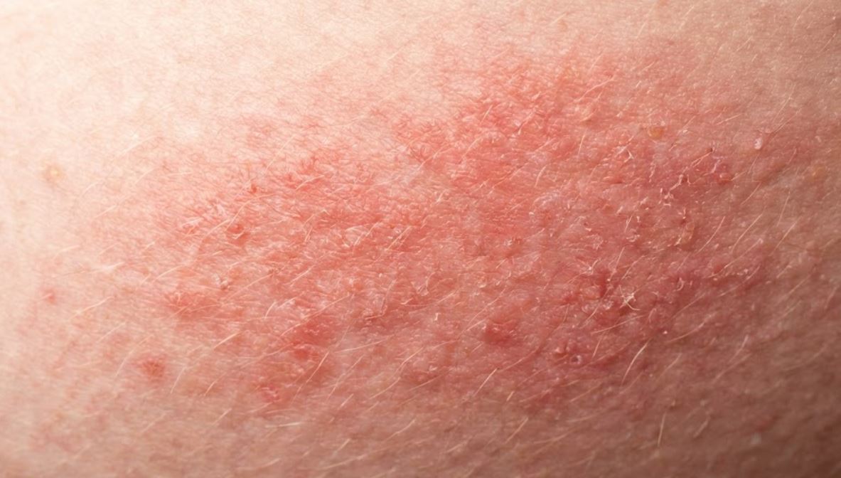 Chafing Between Thighs in Summer