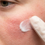 Face Burns While Applying Moisturizer or Lotion