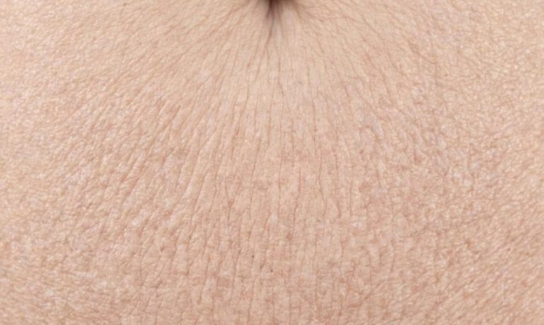 Loose Crepeyon Stomach Skin