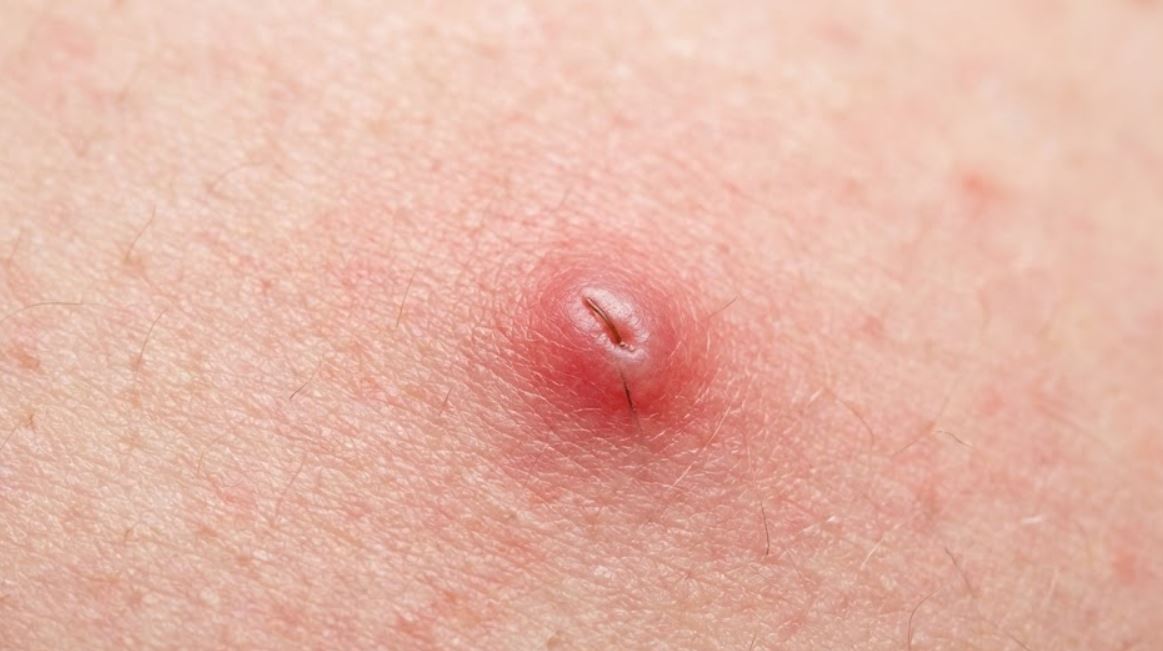 Painful Ingrown Hair on Bikini Line