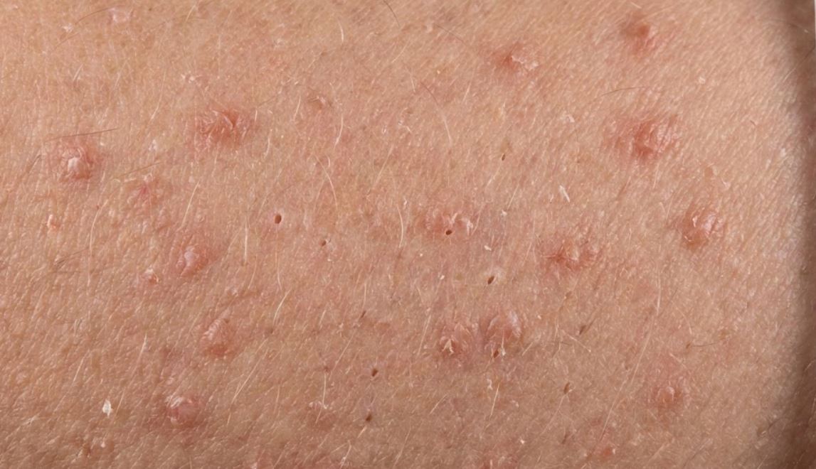 Rough Bumps on Back of Arms