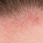Scalp Itches But No Dandruff Flakes: The 5-Step Protocol