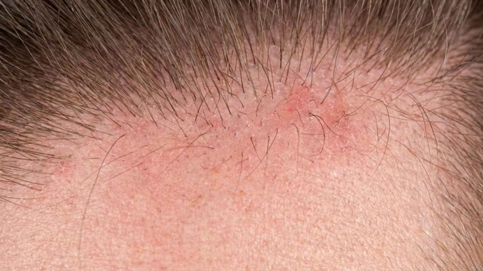 Scalp Itches But No Dandruff Flakes: The 5-Step Protocol