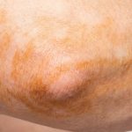 Self-Tanner Streaks on Elbows & Knees