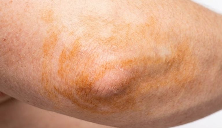 Self-Tanner Streaks on Elbows & Knees