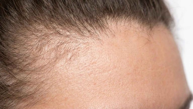 Thinning Edges and Hairline: Causes, Care, Understanding