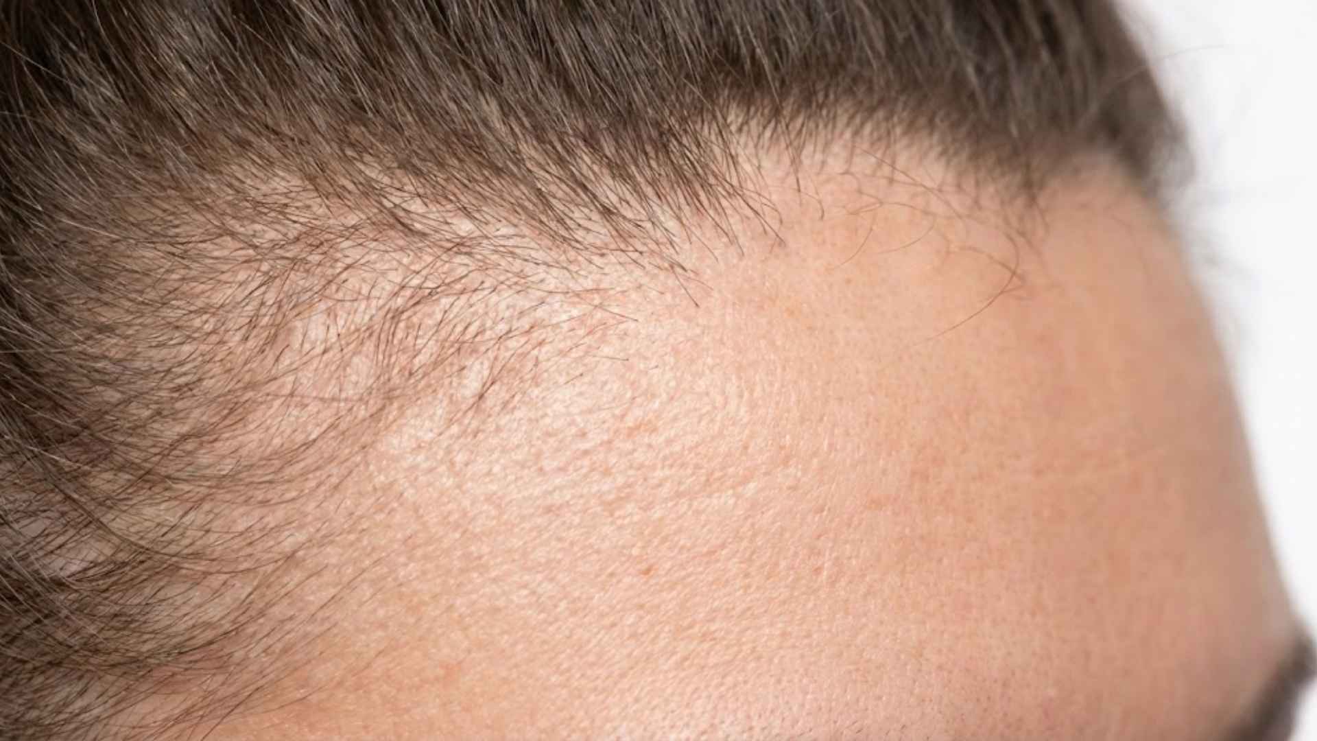 Thinning Edges and Hairline: Causes, Care, Understanding
