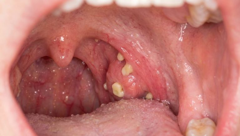 White Chunks in Throat that Smell Bad: The Protocol