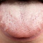 White Coating on Tongue Stop Scraping.