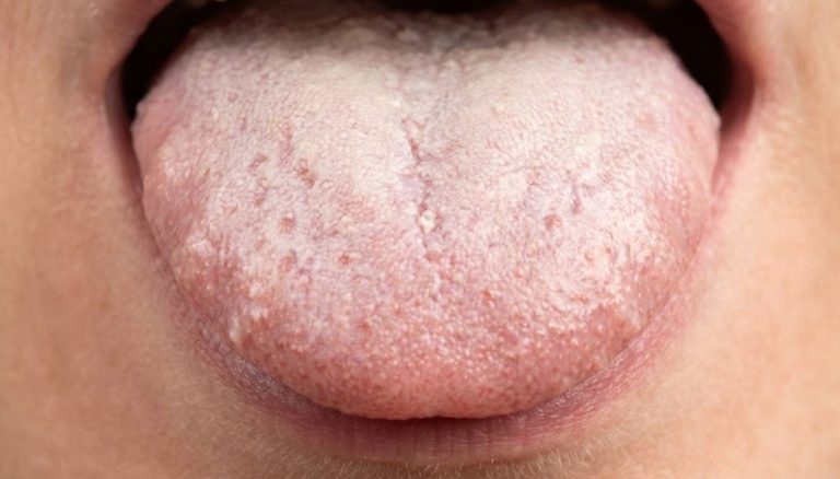White Coating on Tongue Stop Scraping.