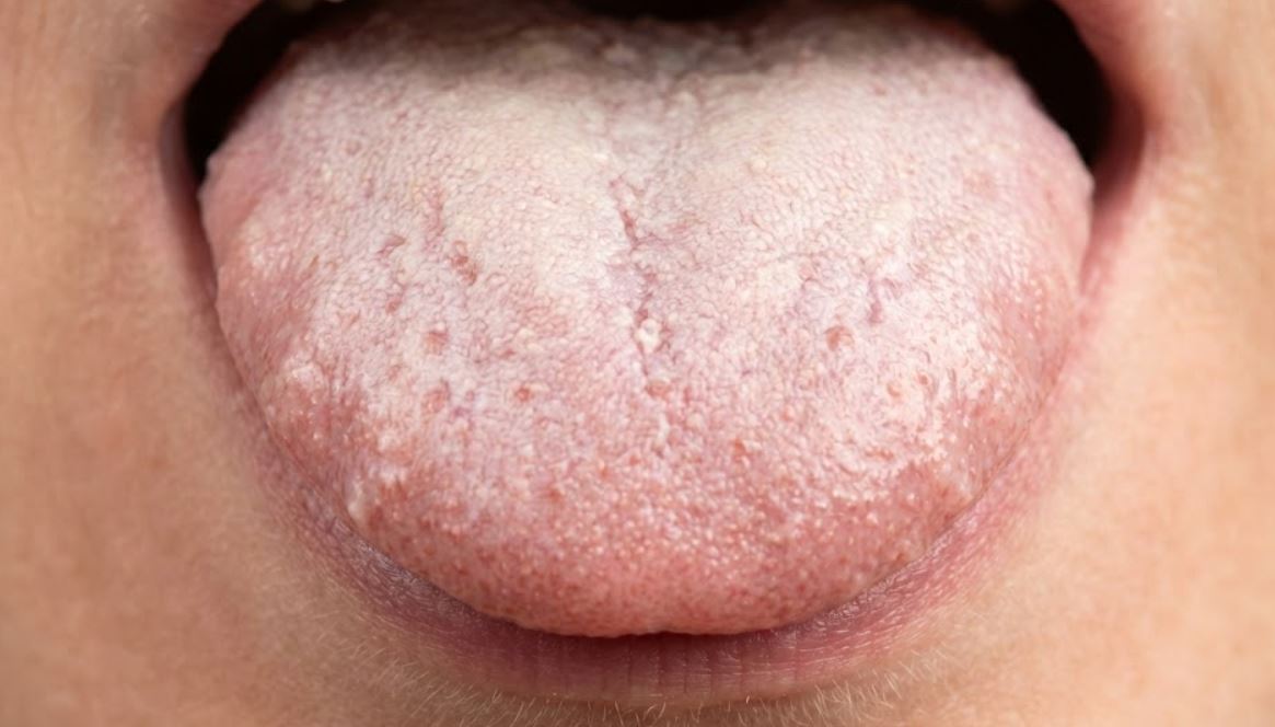 White Coating on Tongue Stop Scraping.