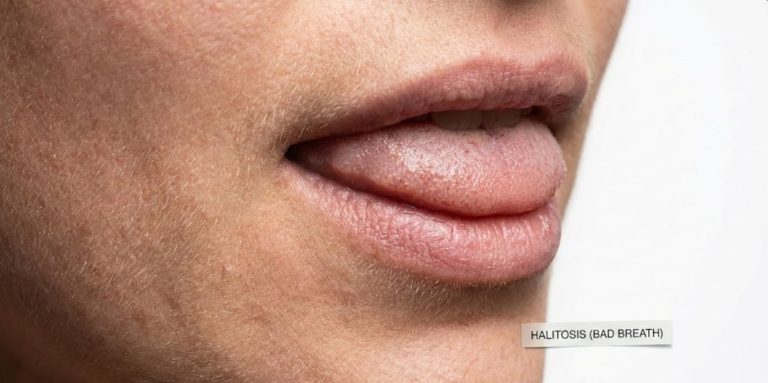 bad breath on mouth