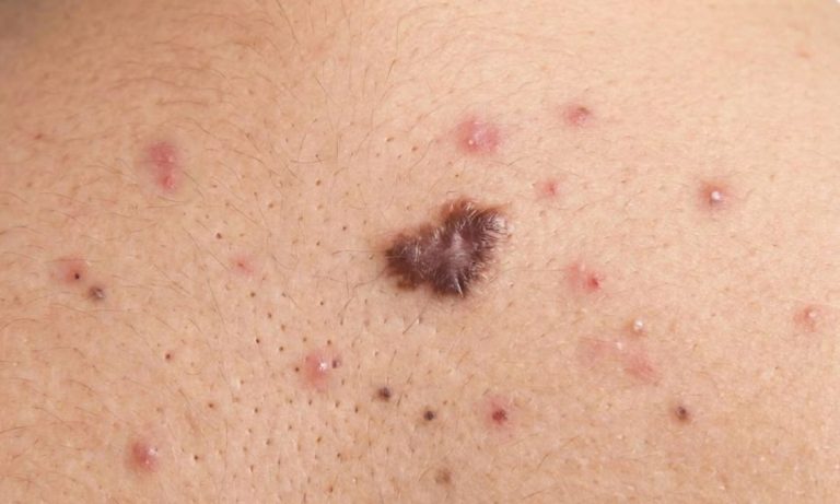 dak scar on back from old acne