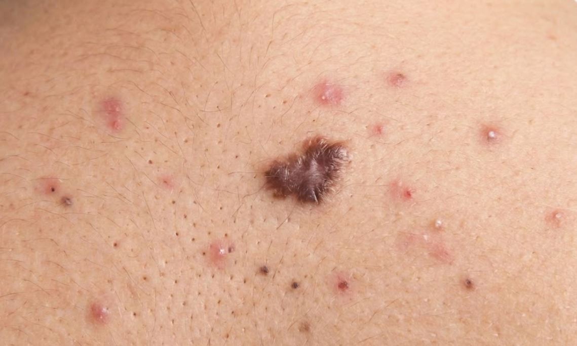 dak scar on back from old acne