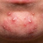 how to get rid of painful pimples on chin