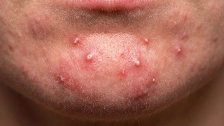 how to get rid of painful pimples on chin