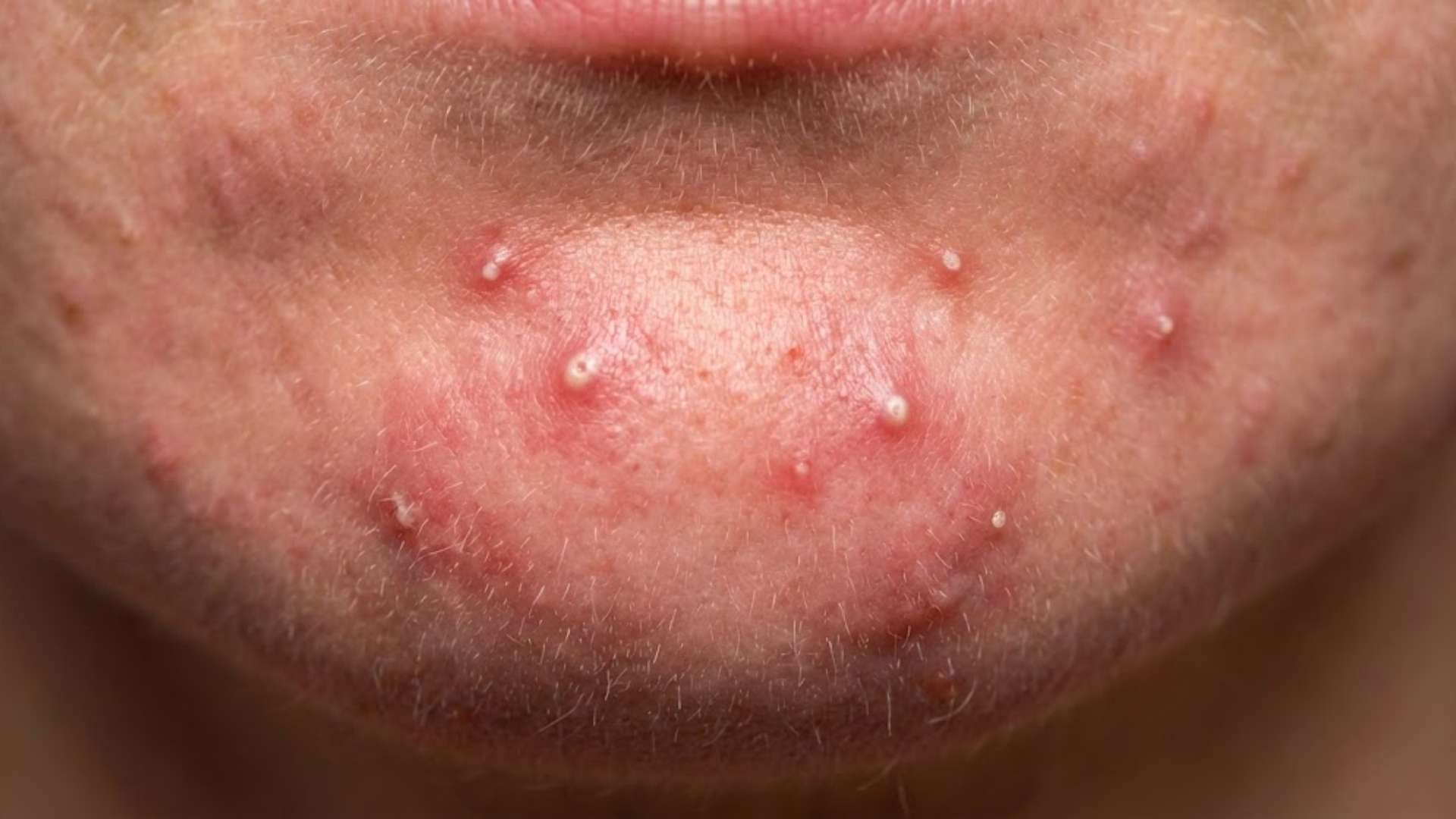 how to get rid of painful pimples on chin