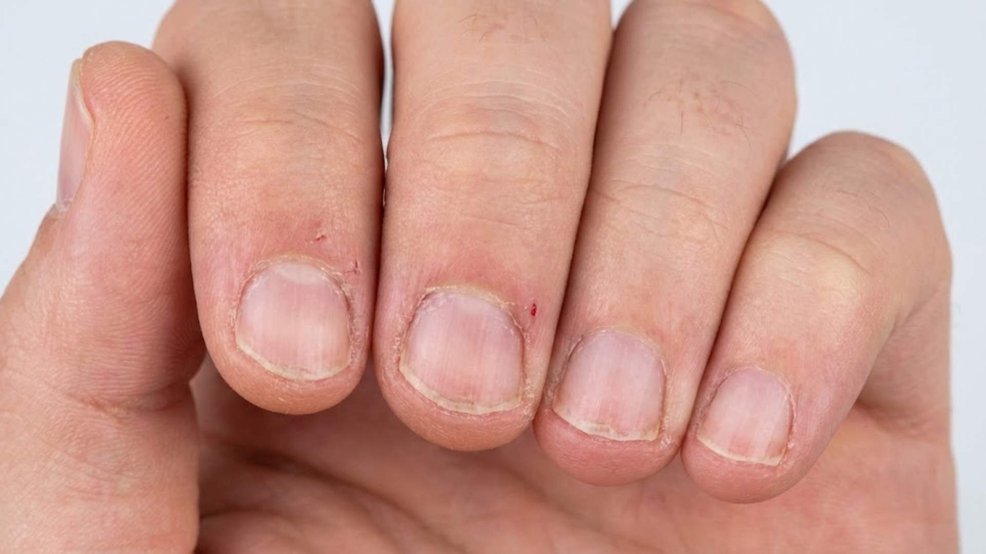 Biting Nails When Anxious Why It Starts & How to Respond