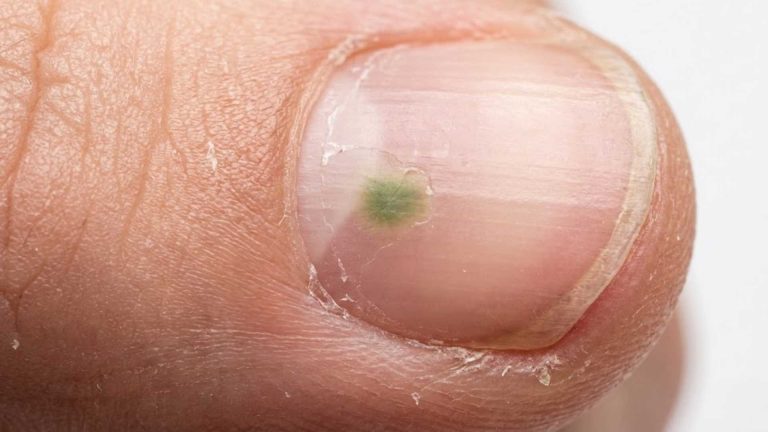 Green Spot Appeared Under Nail Polish Causes & Response
