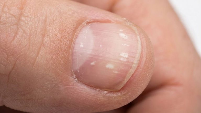 White Spots Appearing on Nail Surface Causes & Guidance
