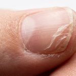 Nails Peeling in Layers at the Tips