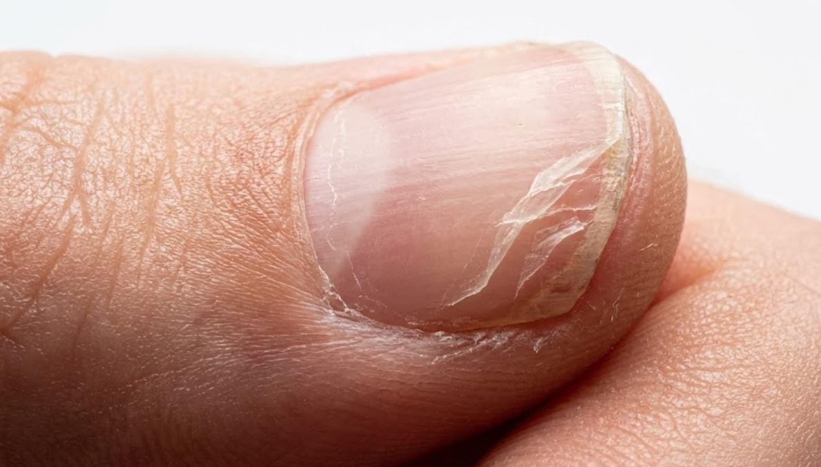 Nails Peeling in Layers at the Tips