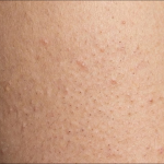Extreme close-up, clinical photograph of keratosis pilaris on upper arm skin, showing characteristic tiny rough bumps, skin texture, pores, and fine vellus hairs.