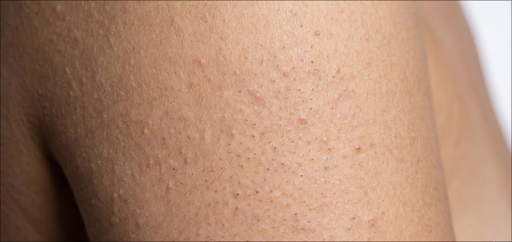 Extreme close-up, clinical photograph of keratosis pilaris on upper arm skin, showing characteristic tiny rough bumps, skin texture, pores, and fine vellus hairs.