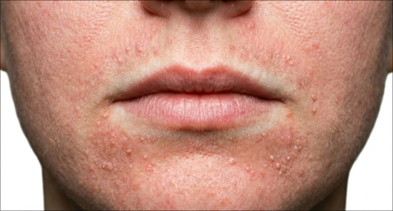 An extreme close-up, clinical-style photograph of perioral dermatitis on the skin around the mouth. The image shows a cluster of small, red inflammatory papules and pustules. A distinct clear band of unaffected skin is visible right next to the lip border. Fine details like skin texture, subtle redness (erythema), and minor scaling are captured under bright, neutral lighting.